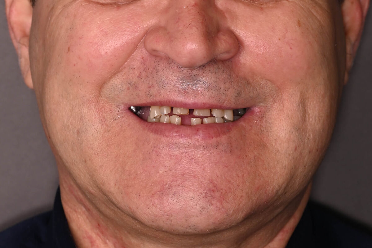 Zâmbet lateral stanga_înainte